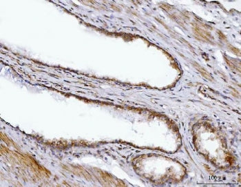 IHC staining of FFPE human prostate cancer tissue with BBS9 antibody. HIER: boil tissue sections in 