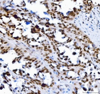 IHC staining of FFPE human ovarian cancer tissue with Transcription factor SP1 antibody. HIER: boil 