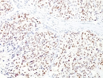 IHC: Formalin-fixed, paraffin-embedded human melanoma stained with MITF antibody cocktail (clones D5