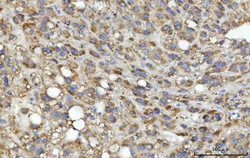 IHC staining of FFPE human liver cancer tissue with SEPT9 antibody. HIER: boil tissue sections in pH