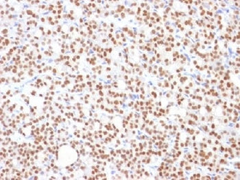 IHC testing of FFPE human thyroid carcinoma with PAX8 antibody (clone PAX8/1492). Required HIER: boi