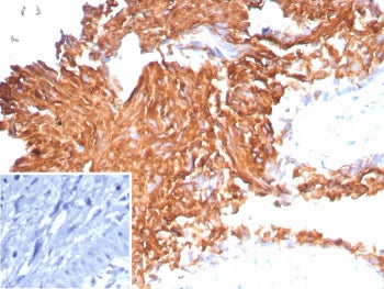 IHC staining of FFPE human bladder carcinoma tissue with recombinant Uroplakin 1B antibody (clone UP