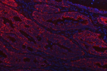 Immunofluorescent staining of FFPE human lung cancer tissue with Thiosulfate sulfurtransferase antib