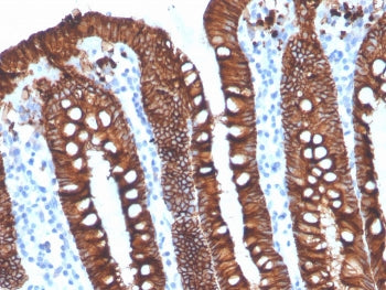IHC staining of FFPE human ovarian carinoma with recombinant EpCAM antibody (clone EGP40/4546R). HIE