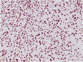 IHC staining of FFPE human epithelioid sarcoma with INI1 antibody (clone SMARCB1/3984). HIER: boil t