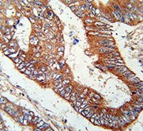 IHC testing of FFPE human colon carcinoma tissue with Kelch-like protein 6 antibody. HIER: steam sec