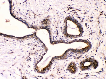 IHC testing of FFPE human breast cancer with Beta III Tubulin antibody at 1ug/ml. HIER: steam sectio