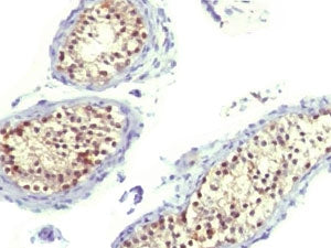 IHC testing of FFPE human testicular carcinoma and Thymidylate Synthase antibody (clone TYSY9). HIER