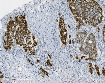 IHC staining of FFPE human gallbladder adenocarcinoma tissue with PTBP2 antibody. HIER: boil tissue 
