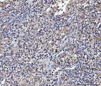 IHC staining of FFPE human glioma tissue with ATP1B2 antibody. HIER: boil tissue sections in pH8 EDT