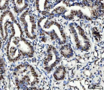 IHC staining of FFPE human cervical cancer tissue with UBE2N antibody. HIER: boil tissue sections in