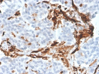 IHC staining of FFPE human tumor with CD31 antibody (clone PECAM1/3526). HIER: boil tissue sections 