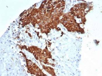 IHC staining of FFPE human ovarian carcinoma tissue with recombinant Beta Tubulin antibody (clone TU