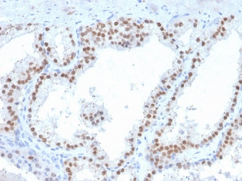IHC staining of FFPE human prostate carcinoma with RET antibody (clone RET/2663). HIER: boil tissue 