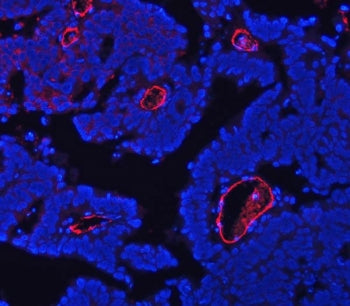 Immunofluorescent staining of FFPE human ovarian cancer tissue with CD105 antibody (red) and DAPI nu