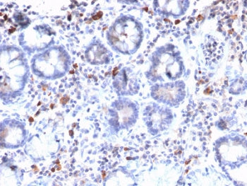 IHC staining of FFPE human gastric carcinoma with MUC3 antibody. HIER: boil tissue sections in 10mM 
