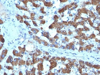 IHC: Formalin-fixed, paraffin-embedded human hepatocellular carcinoma stained with CPS1 antibody (SP