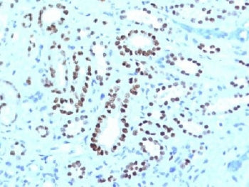 IHC testing of FFPE human renal cell carcinoma with PAX8 antibody cocktail (clone PAX8-1491 + PAX8/1