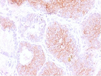 IHC testing of FFPE human prostate carcinoma with CD44v3 antibody (clone CDLA44v3-1). Required HIER: