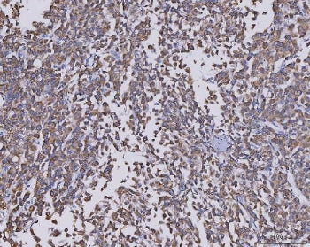 IHC staining of FFPE human liver cancer tissue with CCL14 antibody. HIER: boil tissue sections in pH