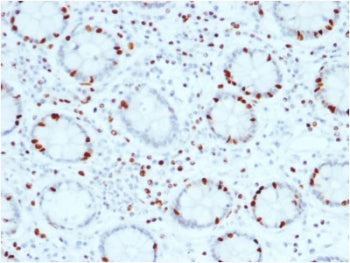 IHC testing of FFPE human colon carcinoma with SOX4 antibody (clone SOX4/2540). HIER: boil tissue se