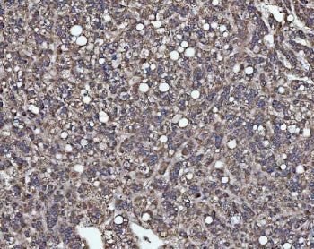 IHC staining of FFPE human liver cancer tissue with SLU7 antibody. HIER: boil tissue sections in pH8