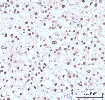 IHC staining of FFPE human liver cancer tissue with Nesprin 3 antibody. HIER: boil tissue sections i