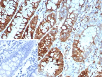 IHC staining of FFPE human colon carcinoma tissue with Oncoprotein 18 antibody (clone STMN1/8439). I