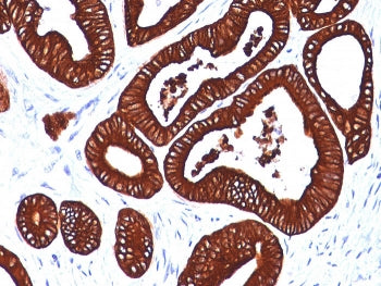 IHC analysis of formalin-fixed, paraffin-embedded human colon carcinoma stained with Keratin 19 anti