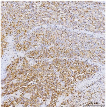 IHC staining of FFPE human melanoma tissue with PPP1R15A antibody. HIER: boil tissue sections in pH8