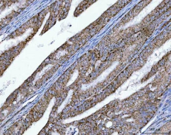 IHC staining of FFPE human endometrial adenocarcinoma tissue with OXSM antibody. HIER: boil tissue s