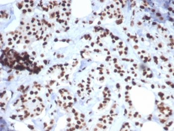 IHC staining of FFPE human breast carcinoma tissue with Heat shock 70 kDa protein 1B antibody (clone
