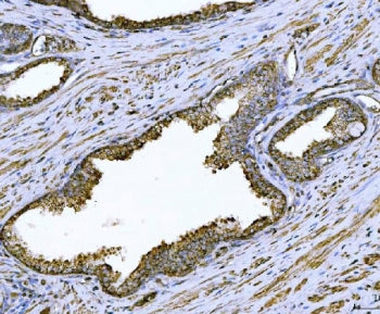 IHC staining of FFPE human prostate cancer tissue with Arg2 antibody. HIER: boil tissue sections in 