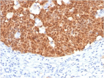 IHC staining of FFPE human cervix with p16INK4a antibody (clone CDKN2A/4499). HIER: boil tissue sect