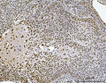 IHC staining of FFPE human laryngeal squamous cell carcinoma tissue with Ataxin 1 antibody. HIER: bo