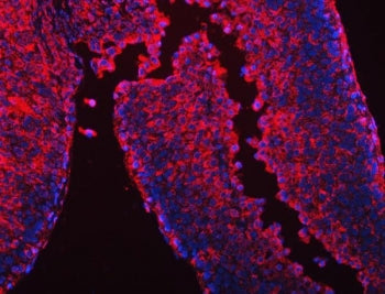 Immunofluorescent staining of FFPE human liver cancer tissue with CES2 antibody (red) and DAPI nucle