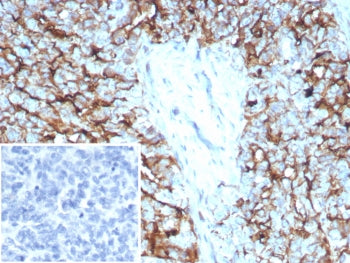 IHC staining of FFPE human ovarian cancer tissue with recombinant Mesothelin antibody (MSLN/8391R). 