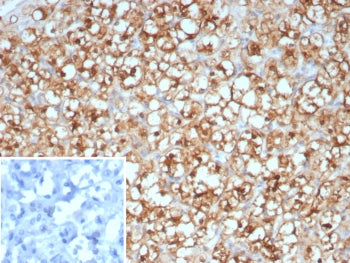 IHC staining of FFPE human renal cell carcinoma tissue with Op18 antibody (clone STMN1/8438). Inset: