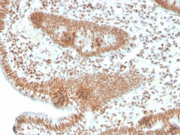 IHC staining of FFPE human colon carcinoma with recombinant PMS2 antibody. HIER: boil tissue section