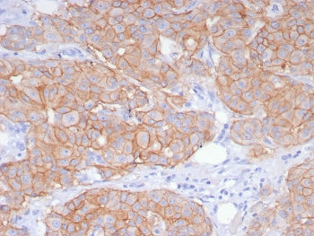 IHC staining of FFPE human breast carcinoma tissue with recombinant HER2 antibody (clone ERBB2/8142R