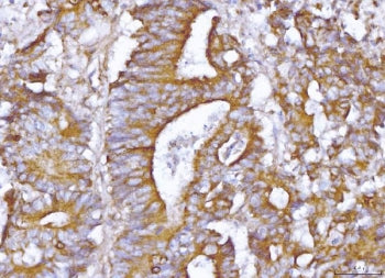 IHC staining of FFPE human colonic adenoma tissue with ABP1 antibody. HIER: boil tissue sections in 