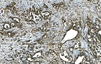 IHC staining of FFPE human stomach cancer tissue with RAB13 antibody. HIER: boil tissue sections in 