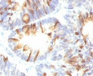 IHC testing of FFPE human colon carcinoma with MUC2 antibody (clone MLP/842). Staining of formalin-f