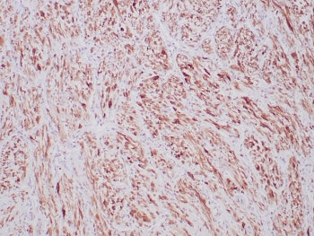 IHC staining of FFPE human inflammatory myofibroblastic tumor with recombinant ALK antibody (clone A