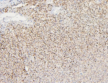 IHC staining of FFPE human renal cancer with Polycystin 2 antibody. HIER: boil tissue sections in pH