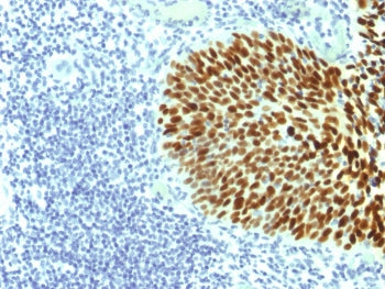 IHC testing of FFPE human cervical carcinoma with SOX-2 antibody (clone SOX2/1791). Required HIER: b