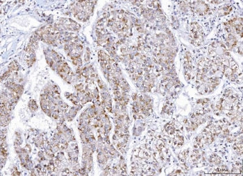 IHC staining of FFPE human liver cancer tissue with E2F transcription factor 3 antibody. HIER: boil 