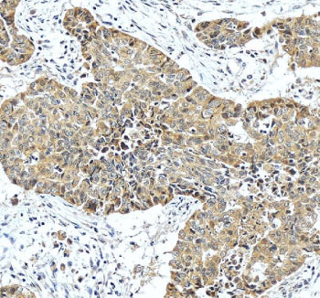 IHC staining of FFPE human liver cancer tissue with HPD antibody, HRP-secondary and DAB substrate. H
