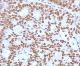 IHC testing of FFPE human endometrial carcinoma with recombinant TLE1 antibody (clone TLEP1-2R). Req