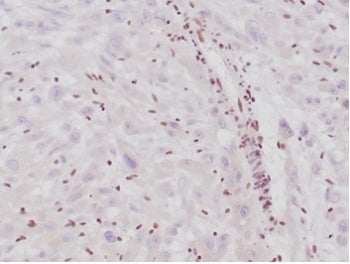 IHC staining of FFPE human epithelioid sarcoma with Integrase interactor 1 antibody (clone SMARCB1/4